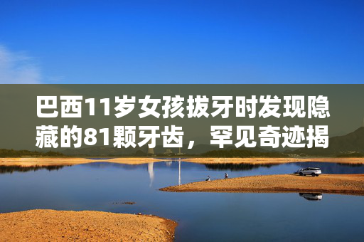 巴西11岁女孩拔牙时发现隐藏的81颗牙齿，罕见奇迹揭晓